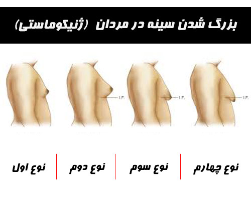 رشد سینه در پسران نوجوان