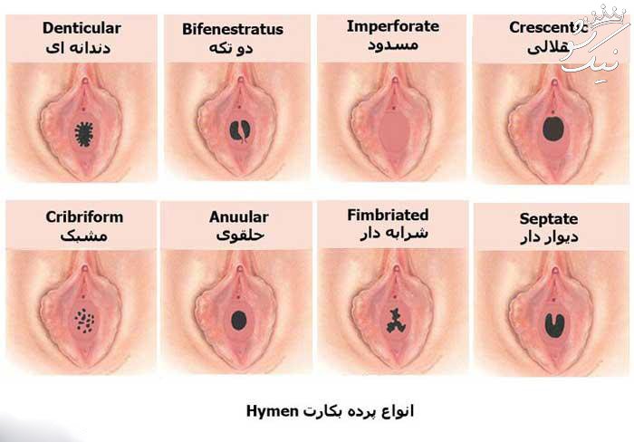 تست پرده بکارت توسط خود شخص و پزشک